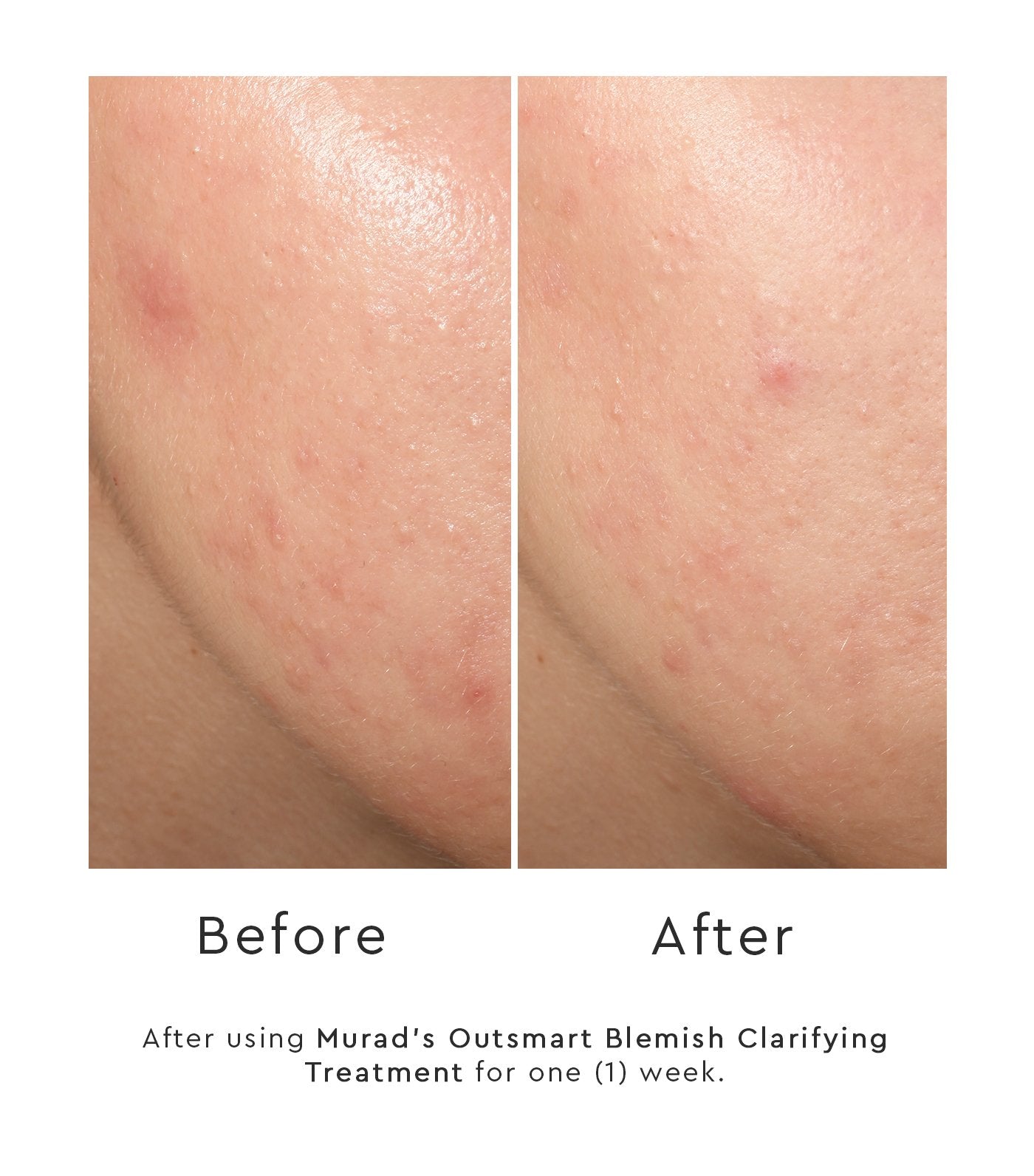 murad outsmart blemish™ treatment